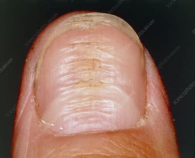 Horizontal ridges on fingernail or nail dystrophy - Stock Image - M140 ...