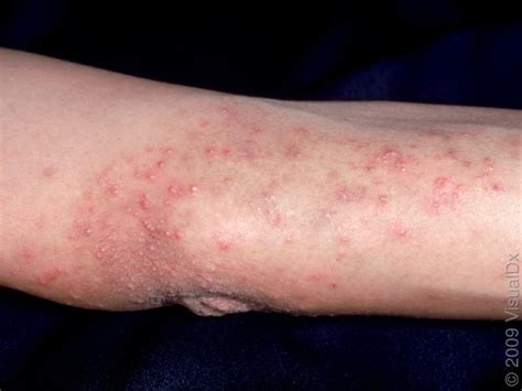 Celiac Disease Rash: Overview, Symptoms and Treatment - HealthPulls