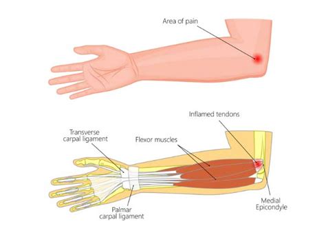 Medial Epicondylitis| Golfer’s Elbow| Flexor Mass Tendon Tear ...