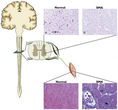 Anterior Horn Cell and Cranial Motor Neuron Disease | Clinical Gate