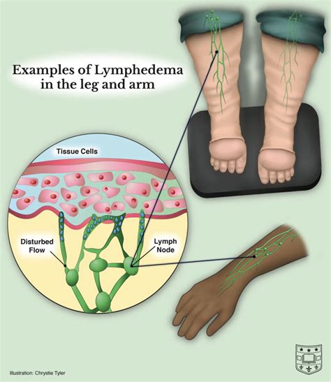 Pain From Lymph Node Removal