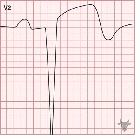 Left Ventricular Aneurysm | ECG Stampede