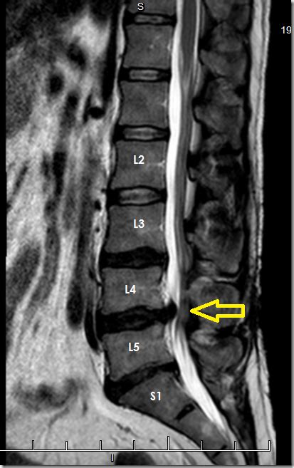 On Lumbar Disc Disease | The Evil Eyebrow