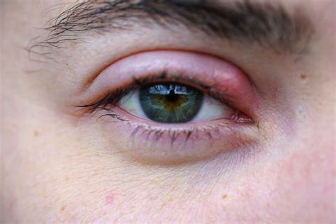 Stye: Signs, Symptoms and Complications