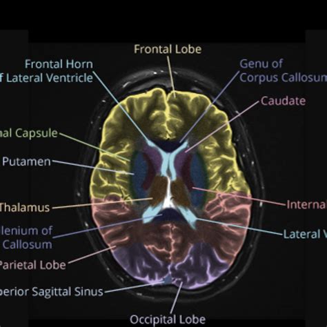 Mri Sectional Anatomy Of Brain Brain Anatomy Mri Frontal Lobe | Images ...