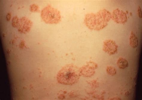 👉 Nummular Eczema - Pictures, Treatment, Causes, Symptoms, Diagnosis ...