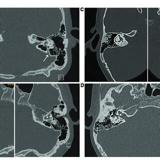 Axial CT scan of the index patients showing both sides. (A,B) Patient ...