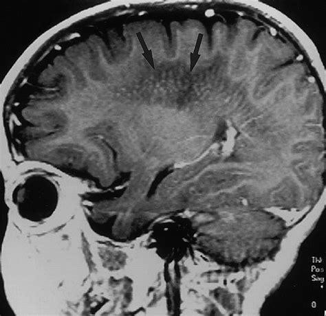 Leukodystrophy in Children: A Pictorial Review of MR Imaging Features ...