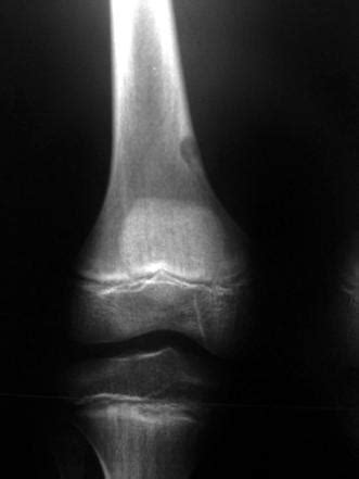 Fibrous cortical defect | Radiology Case | Radiopaedia.org