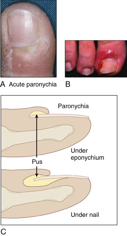 Paronychia Drainage