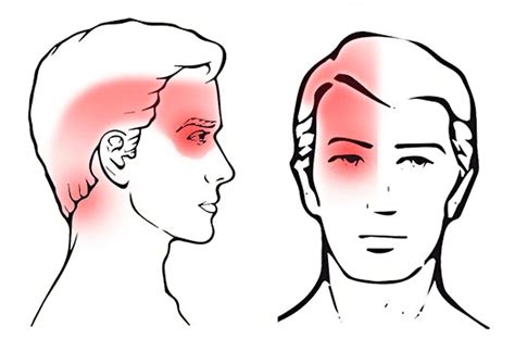 Cervicogenic Headaches: All You Need to Know - Pain Away Clinic