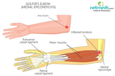 Golfer’s Elbow: Causes, Symptoms and Treatment