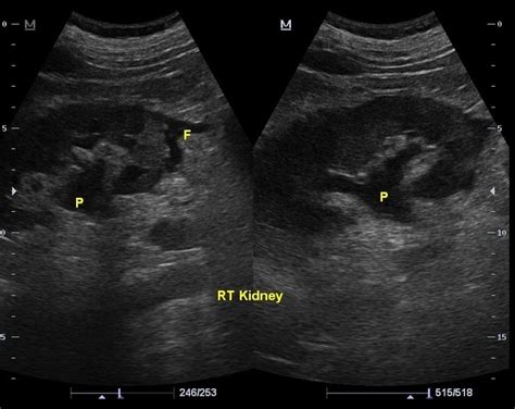 Mild Hydronephrosis Ultrasound