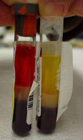 Blood sample hemolysis | Medical Laboratories