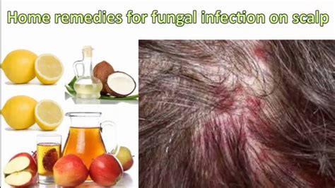 HOME REMEDIES FOR FUNGAL INFECTION IN SCALP | Rowena Leyte - YouTube