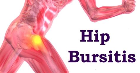 HIP BURSITIS SYMPTOMS, RELIEF AND PHYSICAL THERAPY - Rehab Experts