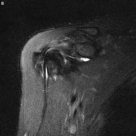 Arthroscopic image of a partial long head of biceps tendon tear (A ...