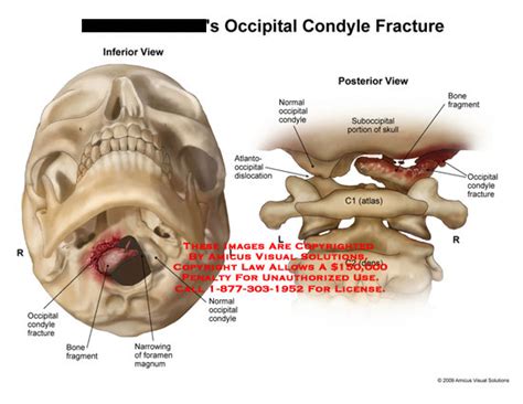 AMICUS Illustration of amicus,injury,fracture,condyle,occipital,bone ...