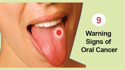 Mouth Cancer Symptoms Warning Signs