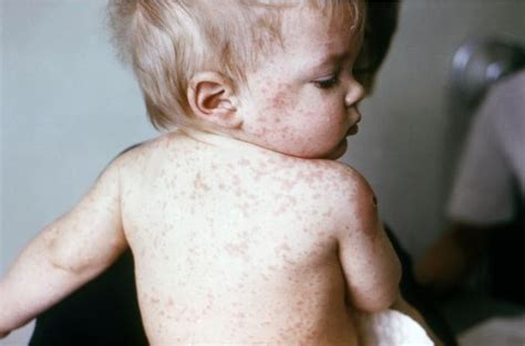 Pediatricians Remember Experiences with Measles