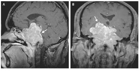 ON - RADIOLOGY: Large Prolactinoma on MRI imaging