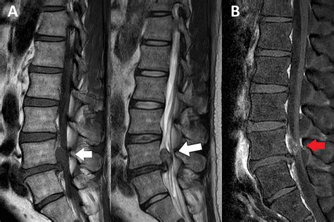 Lumbar Spine Mri Bulging Disc