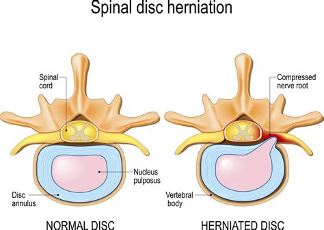 Cervical Radiculopathy | San Antonio Spine Surgeon | Dr.Antonio