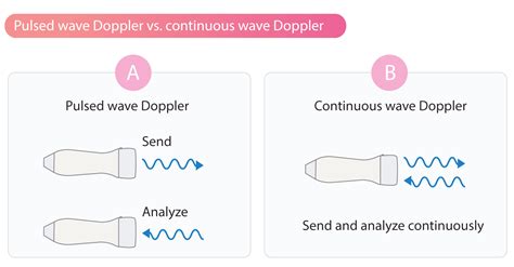 Pulsed Wave Doppler – Cardiovascular Education