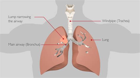 Bronchoscopy | Thoracic Surgery University Hospitals Birmingham