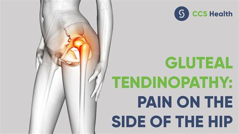 Could my hip pain be gluteal tendinopathy? - Central Coast Spinal Care ...