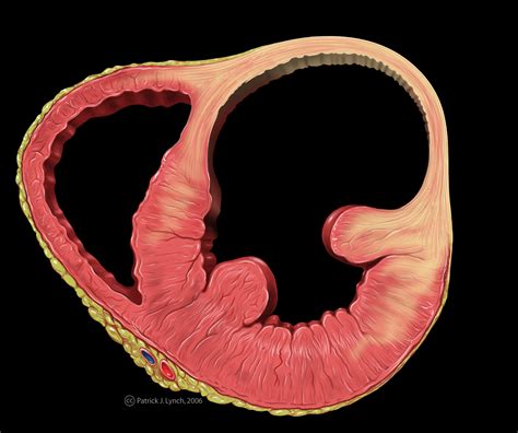 Left ventricular aneurysm pathophysiology - wikidoc