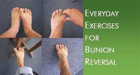 Bunions - Debug Your Health