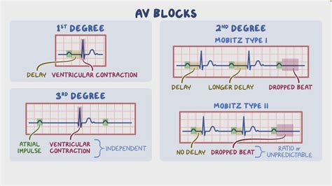 Emergency Management Of Third Degree Heart Block - Free Word Template