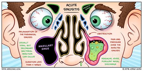 Acute Sinusitis | Acute sinusitis, Sinusitis, Med surg nursing