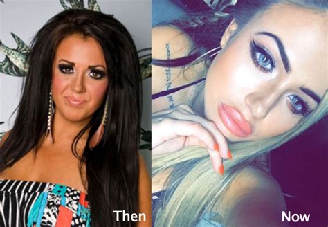 Holly Hagan Plastic Surgery Before and After Photos