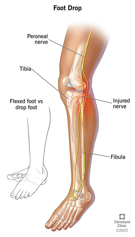 Common Peroneal Neuropathy