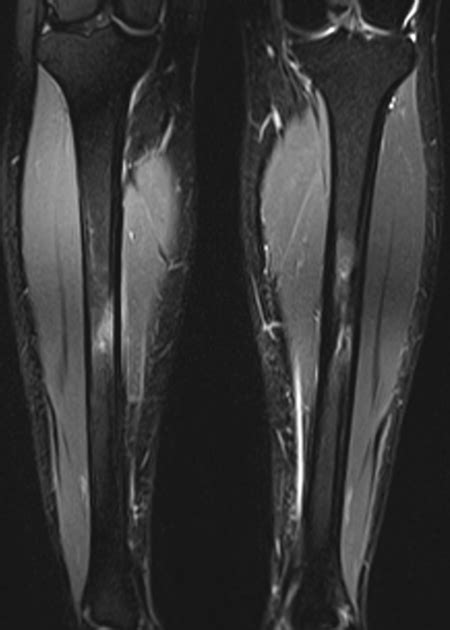 Femoral Neck Stress Fracture Mri