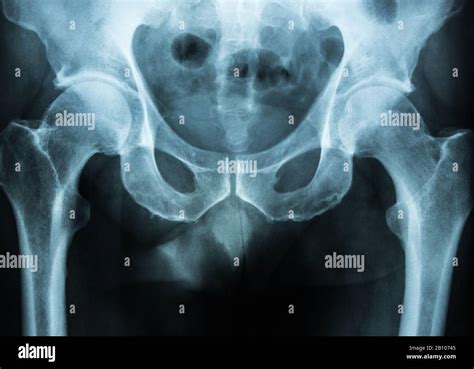 pelvis xray scan Stock Photo - Alamy