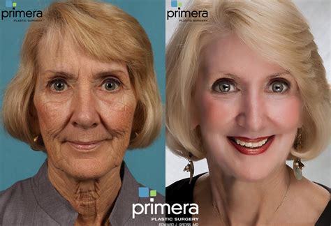 Chemical Peel Before and After Pictures Case 81 | Orlando, Florida ...