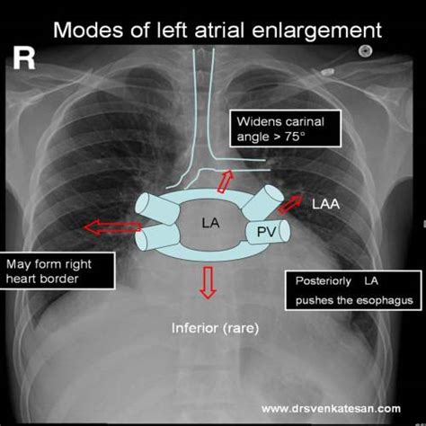 How do you identify left atrial enlargement in X ray Chest ? | Dr.S ...