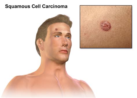 5 Symptoms of Skin Cancer You Should Watch Out For