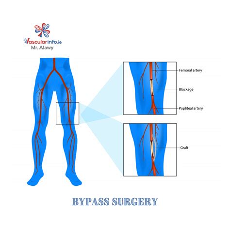 Bypass Surgery - Vascular Info