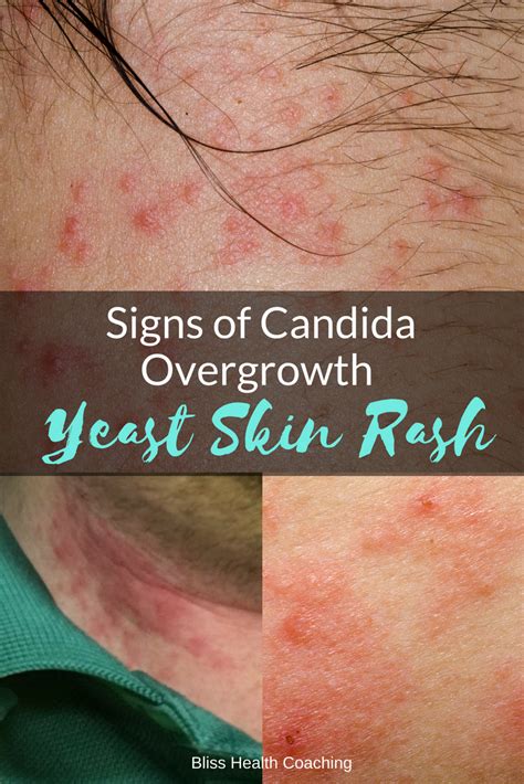 Are you struggling with a yeast rash? Candida overgrowth can cause a ...