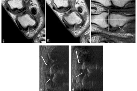 Bone Edema on MRI May Predict Rheumatoid Arthritis | Radiology Report