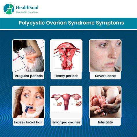 Polycystic Ovarian Syndrome: A Treatable cause of Infertility – Healthsoul