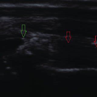 Longitudinal ultrasound image of an intact biceps tendon (red arrows ...