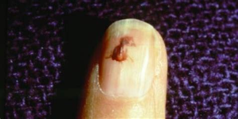 What Is a Splinter Hemorrhage? - Health - NAILS Magazine