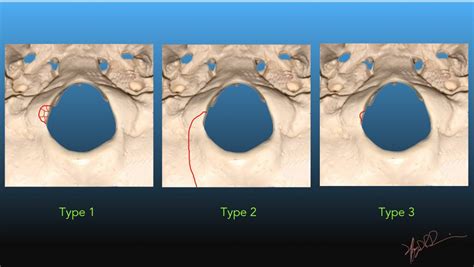 Occipital Condyle Fracture | UW Emergency Radiology