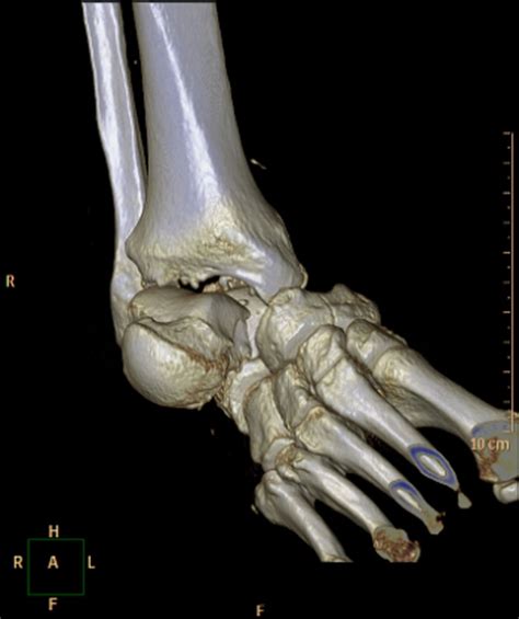 Medial subtalar dislocation with navicular and posterior talar process ...