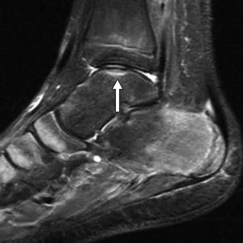 Bone Marrow Edema Patterns in the Ankle and Hindfoot: Distinguishing ...